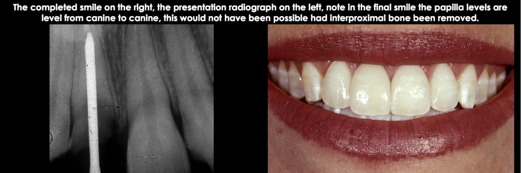 Spear comprehensive guide biologic width 49