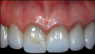 Spear comprehensive guide biologic width 50