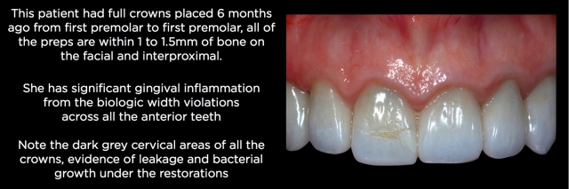 Spear comprehensive guide biologic width 51