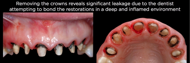 Spear comprehensive guide biologic width 53
