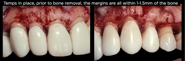 Spear comprehensive guide biologic width 54