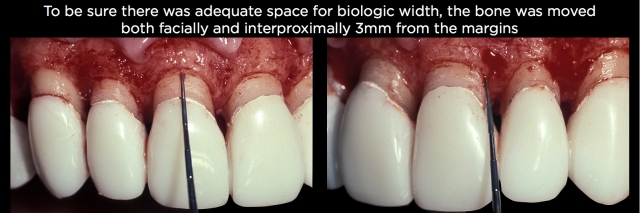 Spear comprehensive guide biologic width 55