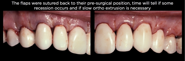 Spear comprehensive guide biologic width 56