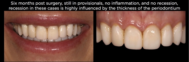 Spear comprehensive guide biologic width 57