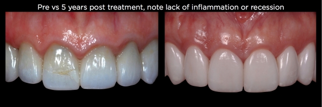 Spear comprehensive guide biologic width 58