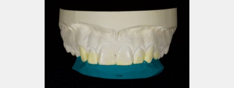 Planning the Class IV: The Workhorse of Cosmetic Dentistry, Part 1