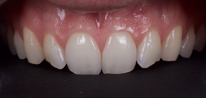 Planning the Class IV: Workhorse of Cosmetic Dentistry, Part 2 Smithson planning class iv part2 01