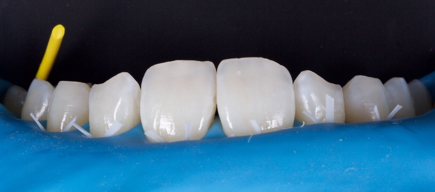 Planning the Class IV: Workhorse of Cosmetic Dentistry, Part 2 Smithson planning class iv part2 02