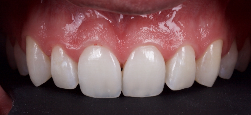 Planning the Class IV: Workhorse of Cosmetic Dentistry, Part 2 Smithson planning class iv part2 04