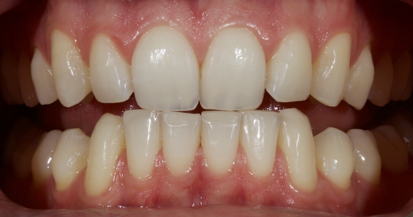 Planning the Class IV: Workhorse of Cosmetic Dentistry, Part 2 Smithson planning class iv part2 05