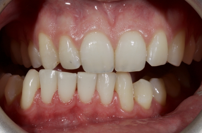 Planning the Class IV: Workhorse of Cosmetic Dentistry, Part 2 Smithson planning class iv part2 07