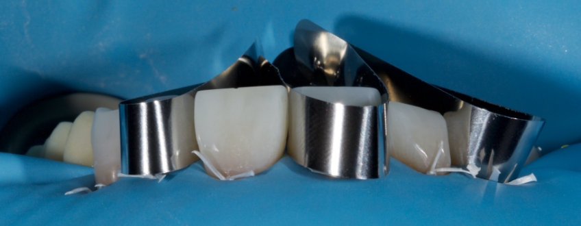 Planning the Class IV: Workhorse of Cosmetic Dentistry, Part 2 Smithson planning class iv part2 09