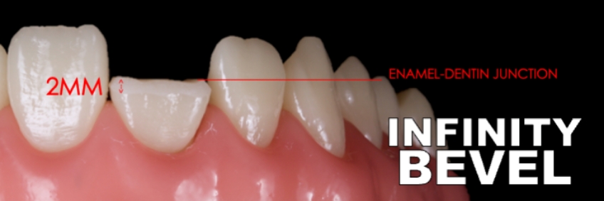 Planning the Class IV: Workhorse of Cosmetic Dentistry, Part 2 Smithson planning class iv part2 10