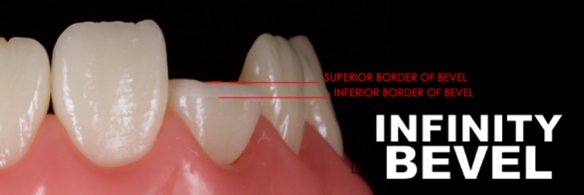 Planning the Class IV: Workhorse of Cosmetic Dentistry, Part 2 Smithson planning class iv part2 11
