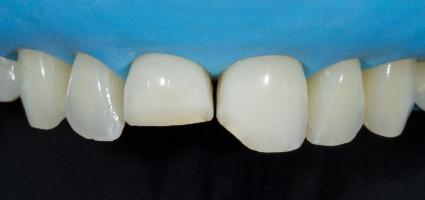 Planning the Class IV: Workhorse of Cosmetic Dentistry, Part 2 Smithson planning class iv part2 12