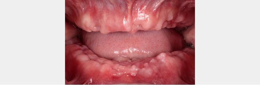 Loading Protocols for Implant Overdentures: To Wait or Not to Wait? Dichter loading protocals for implants 02