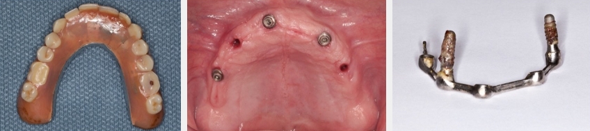 Loading Protocols for Implant Overdentures: To Wait or Not to Wait? Dichter loading protocals for implants 04