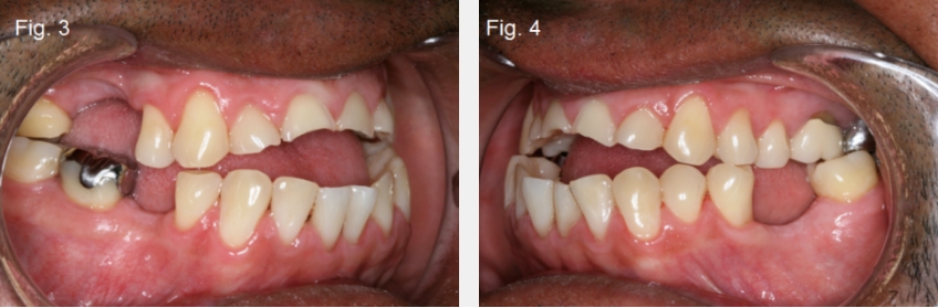 A Guide to Anterior Open Bites 2FrankSpear AnteriorOpenBites Fig.3 4