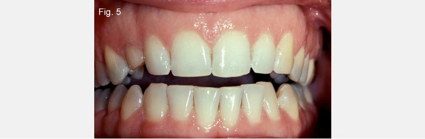 A Guide to Anterior Open Bites 2FrankSpear AnteriorOpenBites Fig.5
