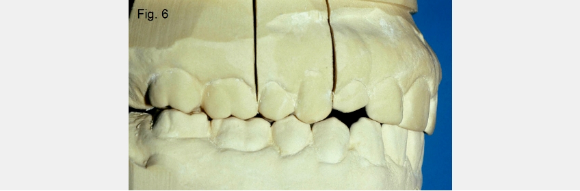 A Guide to Anterior Open Bites 2FrankSpear AnteriorOpenBites Fig.6