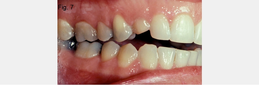 A Guide to Anterior Open Bites 2FrankSpear AnteriorOpenBites Fig.7