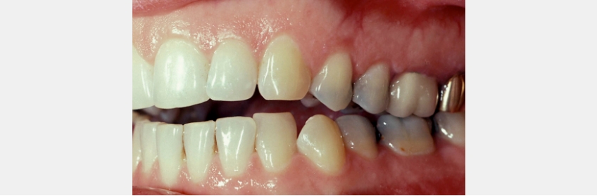 A Guide to Anterior Open Bites 2FrankSpear AnteriorOpenBites Fig.8