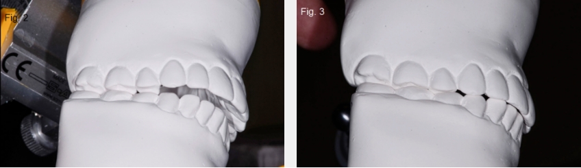 A Guide to Anterior Open Bites FrankSpear AnteriorOpenBites Fig. 2B 3B