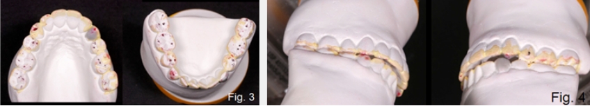 A Guide to Anterior Open Bites FrankSpear AnteriorOpenBites Fig. 3C 4C