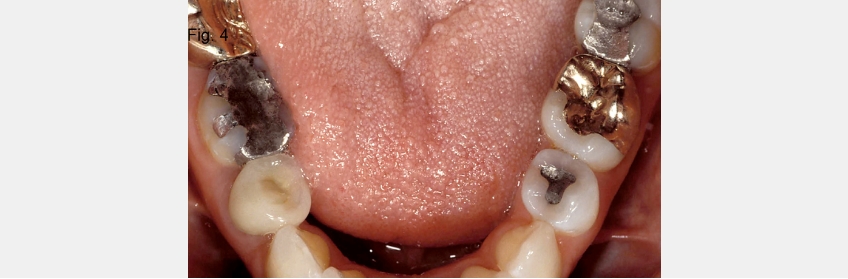 A Guide to Anterior Open Bites FrankSpear AnteriorOpenBites Fig. 4B