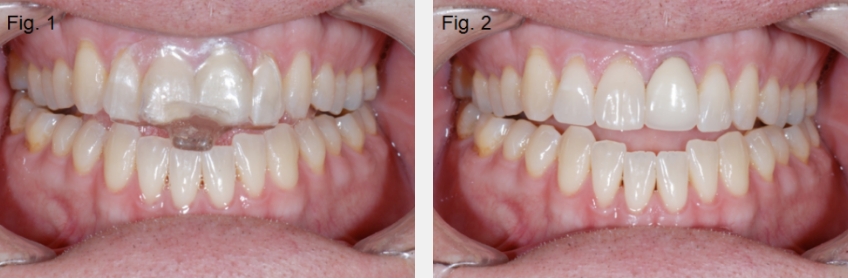 A Guide to Anterior Open Bites FrankSpear AnteriorOpenBites Fig.1 2