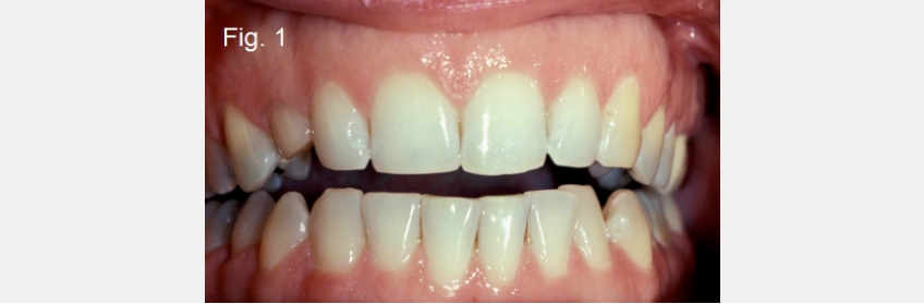 A Guide to Anterior Open Bites FrankSpear AnteriorOpenBites Fig.1A