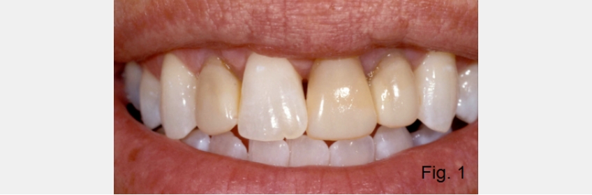 A Guide to Anterior Open Bites FrankSpear AnteriorOpenBites Fig.1C