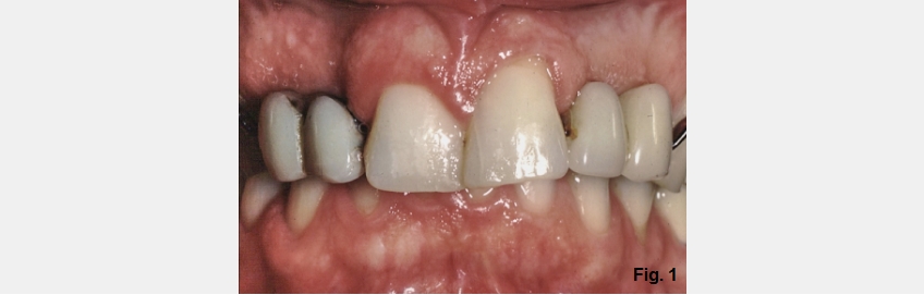 A Guide to Anterior Open Bites FrankSpear AnteriorOpenBites Fig.1D