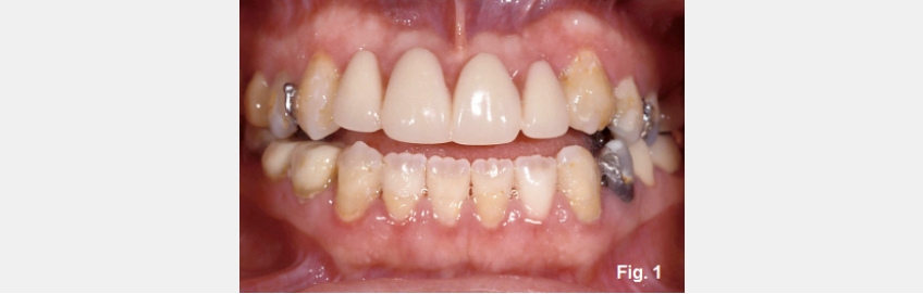 A Guide to Anterior Open Bites FrankSpear AnteriorOpenBites Fig.1E