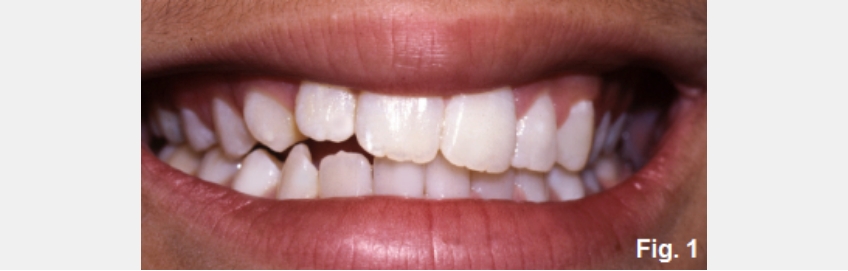 A Guide to Anterior Open Bites FrankSpear AnteriorOpenBites Fig.1F