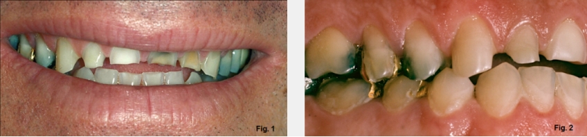 A Guide to Anterior Open Bites FrankSpear AnteriorOpenBites Fig.1G 2G
