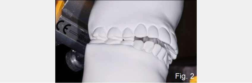 A Guide to Anterior Open Bites FrankSpear AnteriorOpenBites Fig.2C