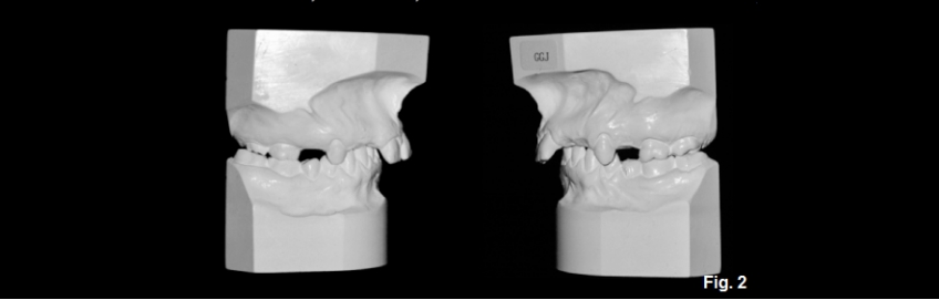 A Guide to Anterior Open Bites FrankSpear AnteriorOpenBites Fig.2D