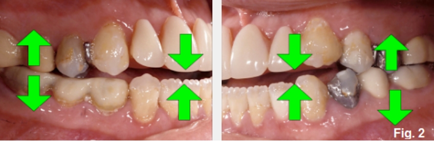 A Guide to Anterior Open Bites FrankSpear AnteriorOpenBites Fig.2E