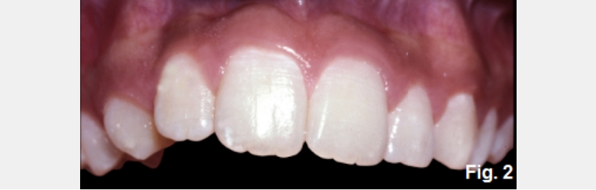 A Guide to Anterior Open Bites FrankSpear AnteriorOpenBites Fig.2F