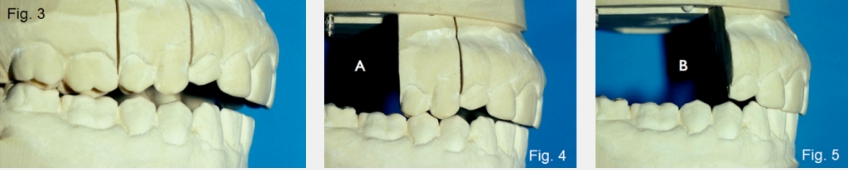 A Guide to Anterior Open Bites FrankSpear AnteriorOpenBites Fig.3A 5A