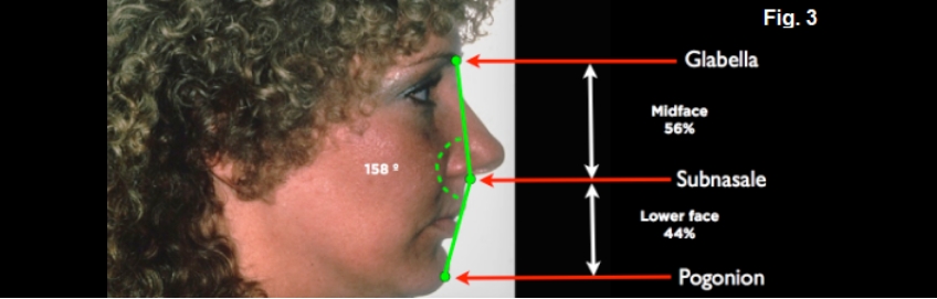 A Guide to Anterior Open Bites FrankSpear AnteriorOpenBites Fig.3D 1