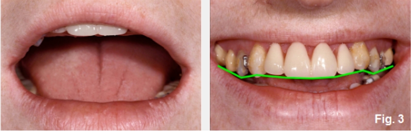A Guide to Anterior Open Bites FrankSpear AnteriorOpenBites Fig.3E