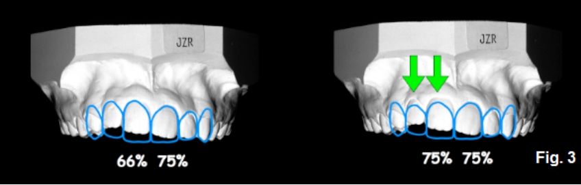 A Guide to Anterior Open Bites FrankSpear AnteriorOpenBites Fig.3F