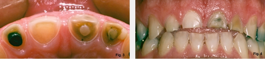 A Guide to Anterior Open Bites FrankSpear AnteriorOpenBites Fig.3G 4G