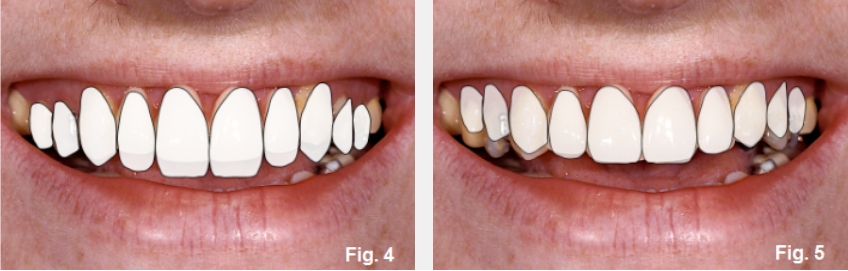 A Guide to Anterior Open Bites FrankSpear AnteriorOpenBites Fig.4E 5E