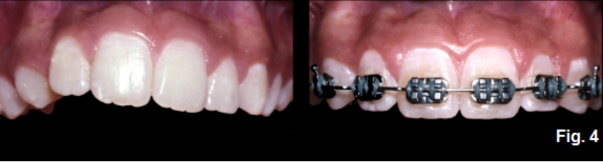 A Guide to Anterior Open Bites FrankSpear AnteriorOpenBites Fig.4F