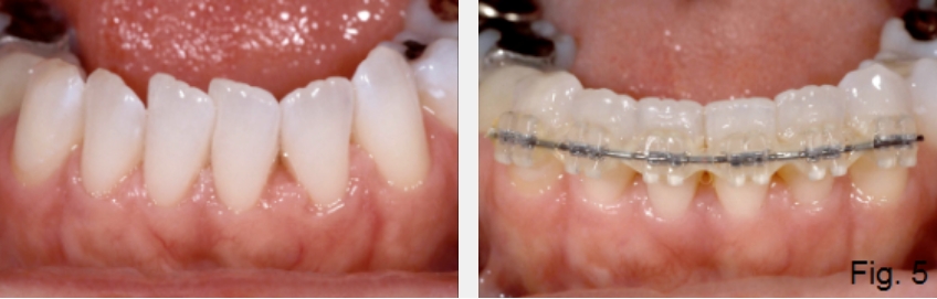 A Guide to Anterior Open Bites FrankSpear AnteriorOpenBites Fig.5C