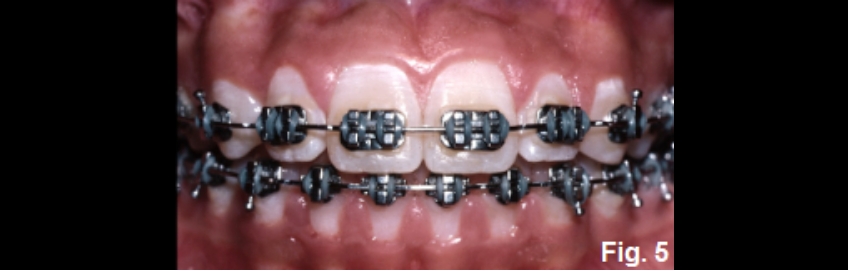 A Guide to Anterior Open Bites FrankSpear AnteriorOpenBites Fig.5F