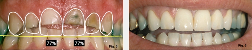 A Guide to Anterior Open Bites FrankSpear AnteriorOpenBites Fig.5G 6G